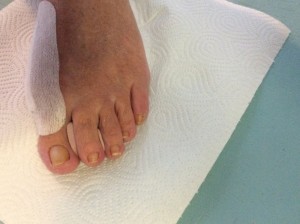 Orthose nach hallugs valgus Op