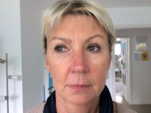 Faltenunterspritzung nach der Behandlung mit "Restylane"