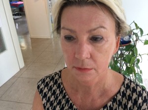 Faltenunterspritzung nach der Behandlung mit "Restylane"